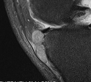 Bursa Knee Deep Infrapatella